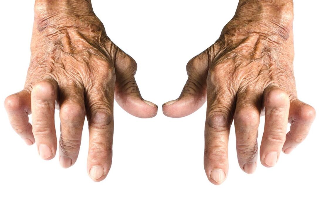 Signs of Arthritis - Joint Deformities