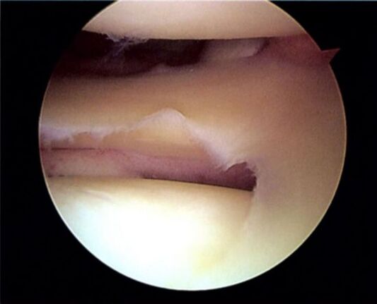 Meniscus tear leading to knee osteoarthritis