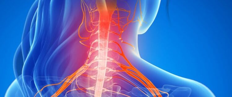 Cervical osteochondrosis compresses spinal cord blood vessels