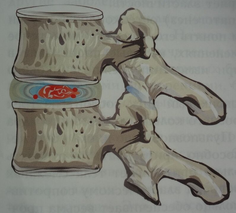 Injury of the nucleus pulposus of the intervertebral disc in the first stage of cervical osteochondrosis