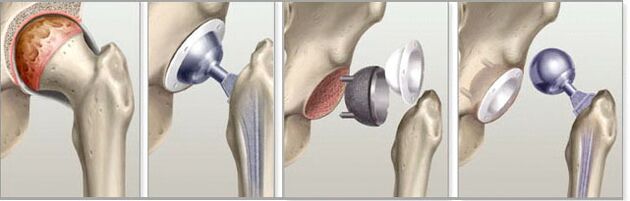 Hip Replacement for Arthropathy