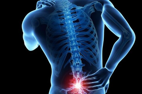 Acute low back pain is a symptom of a displaced disc