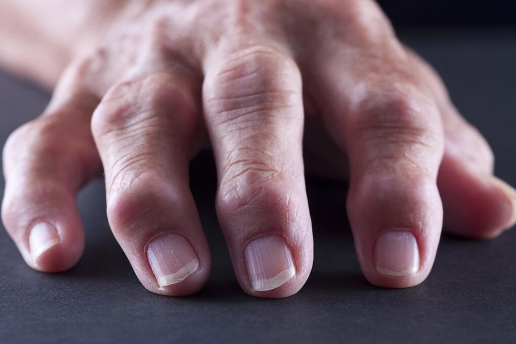 Bursitis is characterized by pain, inflammation, and swelling of the finger joints