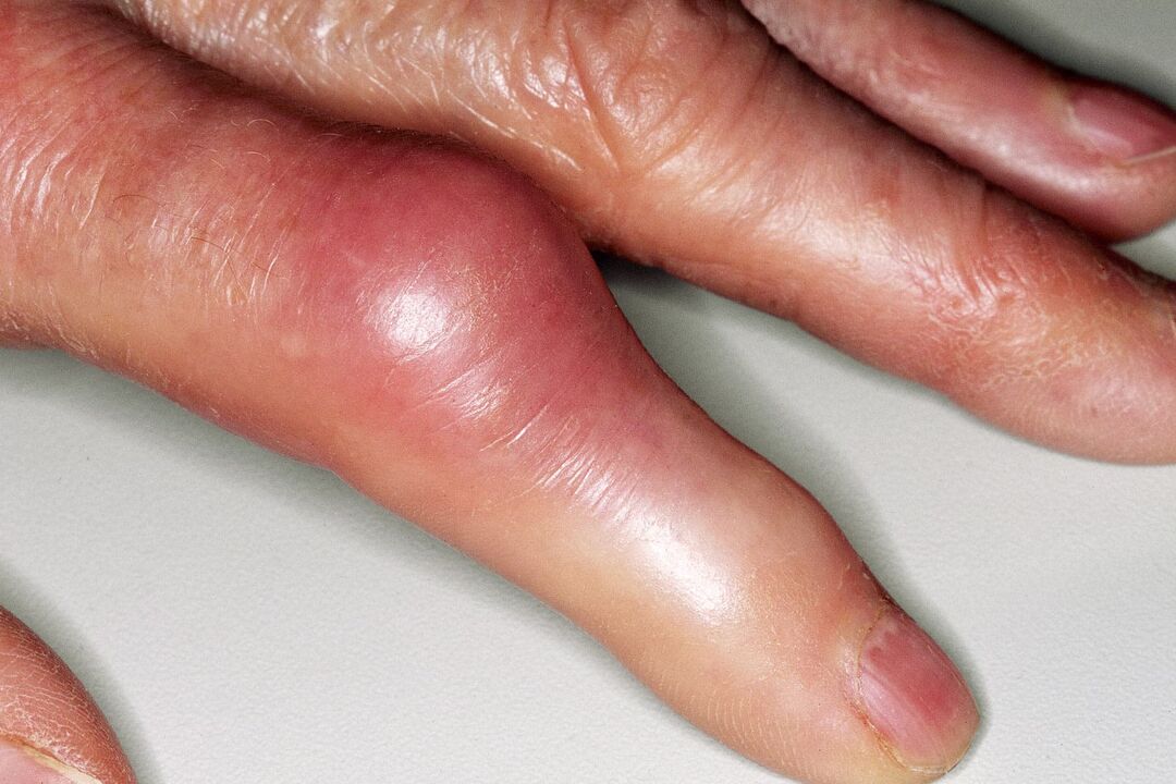 Finger joint swelling, deformation, and acute pain after injury