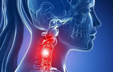 Osteochondral disease on the neck