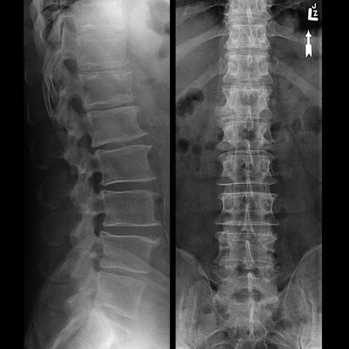 Use osteocartilage op