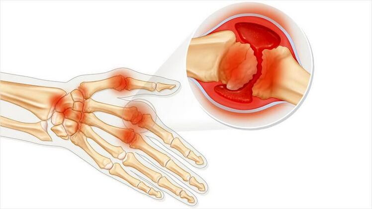 Arthritis causes damage to hand joints