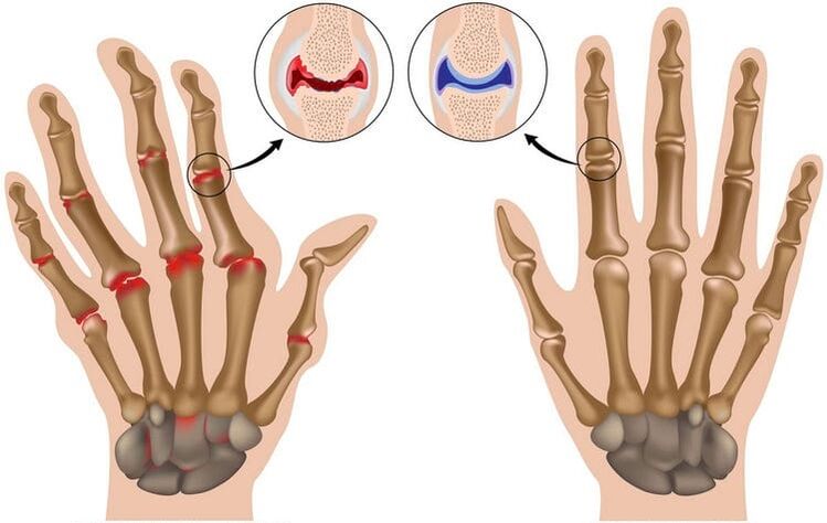 Healthy hand joints and joints damaged by joint injury