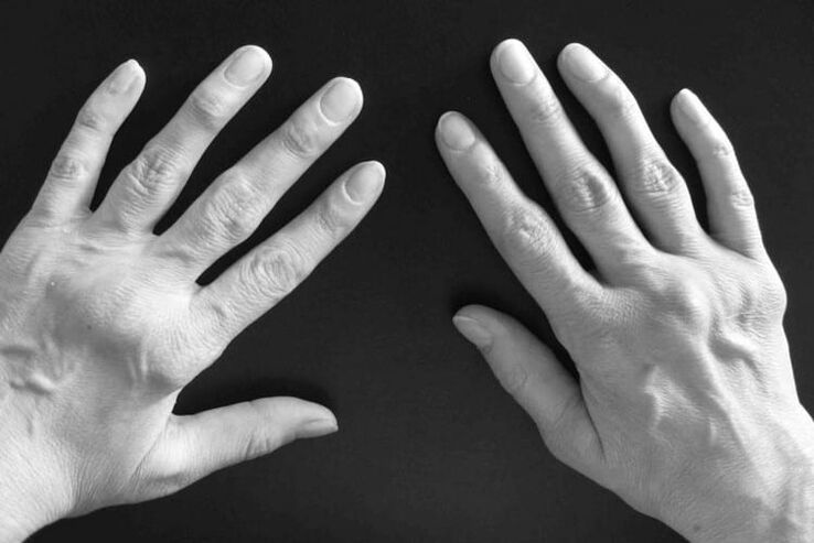 Symptoms of arthritis in hand joints