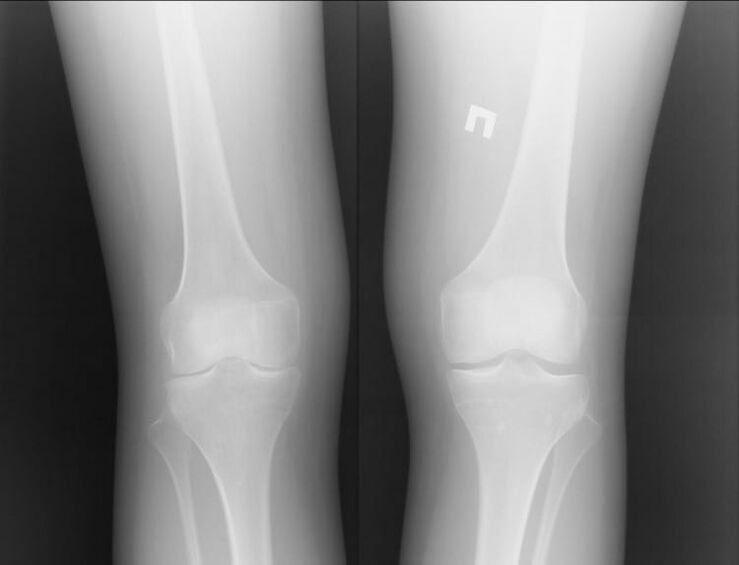 X-ray of knee affected by joint
