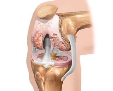 Destruction of knee joint caused by joint