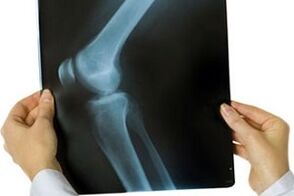 Knee joint on x-ray
