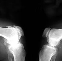 joints on x-ray